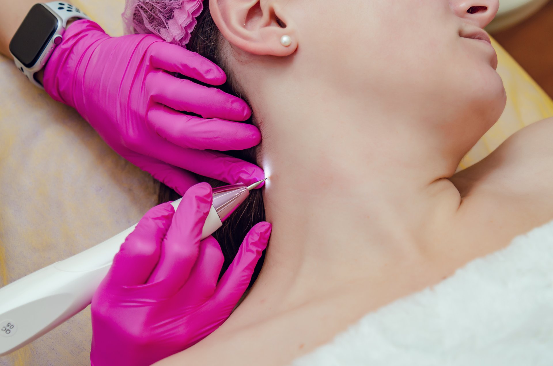 Skin Tag Removal