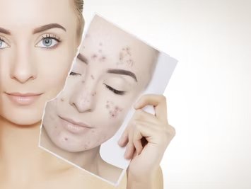 Acne Facial