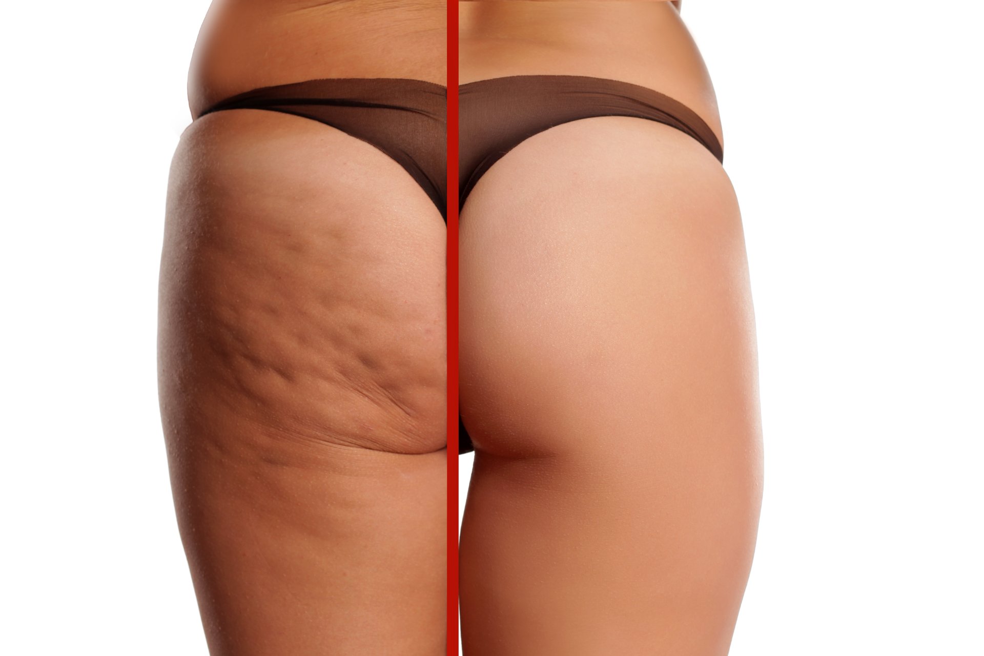 Anti-Cellulite